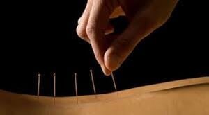 What is Acupuncture